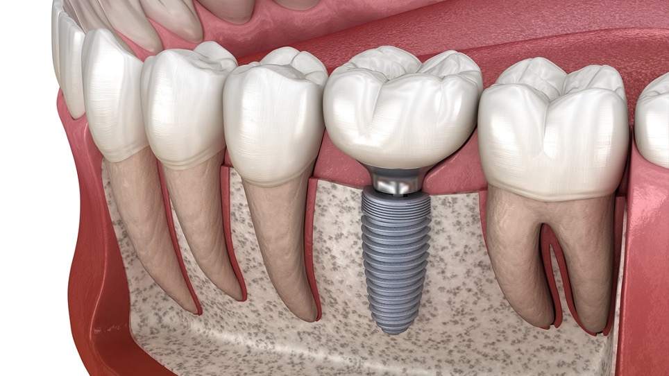 Illustrazione di un impianto dentale nell’osso che sostiene una corona al posto di un dente mancante