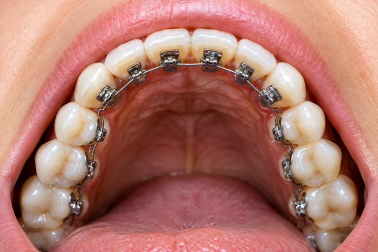Bracket e filo ortodontico sul lato interno dei denti, immagine illustrativa dell’ortodonzia linguale.