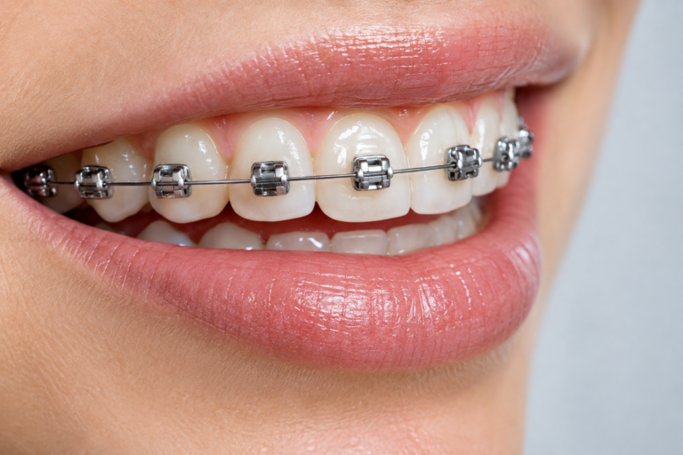 Primo piano di bracket metallici sui denti, immagine illustrativa dell’apparecchio ortodontico.