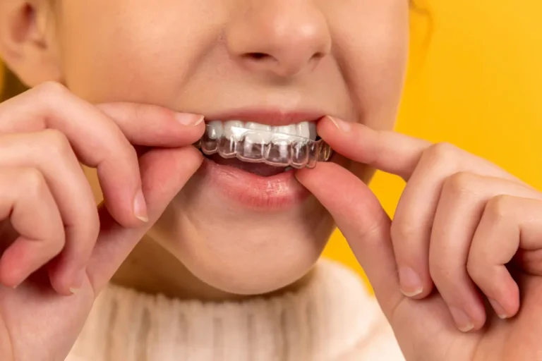 Persona che inserisce un allineatore trasparente sui denti, foto illustrativa della guida dello Studio Dentistico Baldari agli allineatori.