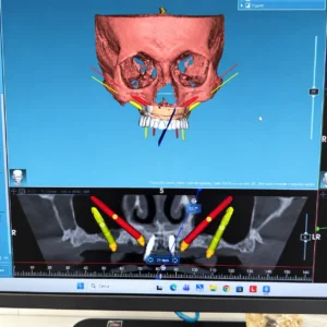 Monitor con ricostruzione tridimensionale del mascellare e progetto implantare nei casi di poco osso